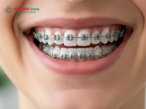 20 tuổi niềng răng được không? Chi phí, thời gian & mức độ hiệu quả缩略图