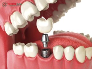 Cấy ghép Implant là gì? Phương pháp, Quy trình, Ưu nhược điểm và Chi phí缩略图
