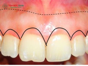 Điều trị cười hở lợi hiệu quả: Nguyên nhân, chi phí, cách chữa缩略图