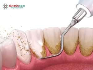 Top dụng cụ vệ sinh răng niềng không thể thiếu缩略图