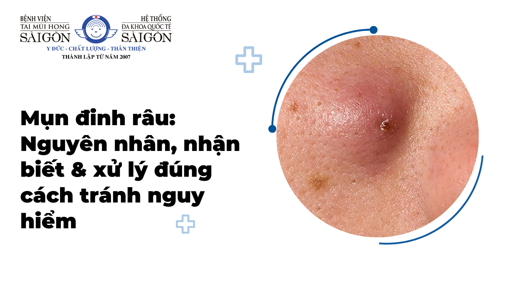 Mụn đinh râu: Nguyên nhân, nhận biết & xử lý đúng cách tránh nguy hiểm缩略图