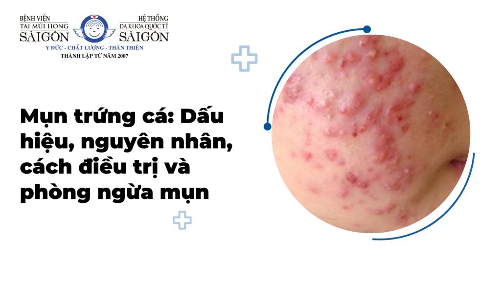 Mụn trứng cá: Dấu hiệu, nguyên nhân, cách điều trị và phòng ngừa mụn缩略图