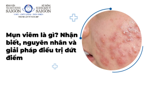 Mụn viêm là gì? Nhận biết, nguyên nhân và giải pháp điều trị dứt điểm缩略图