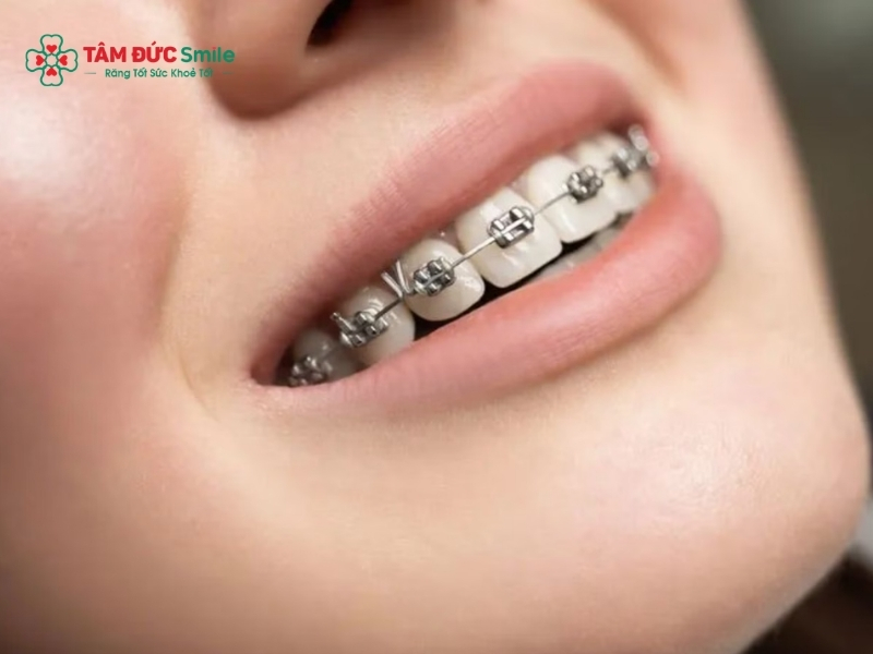 Niềng răng 1 hàm mất bao lâu? Thời gian, chi phí & mức độ hiệu quả缩略图