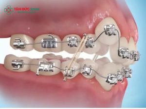 Niềng răng hô nặng: Chi phí, thời gian & phác đồ điều trị chi tiết缩略图