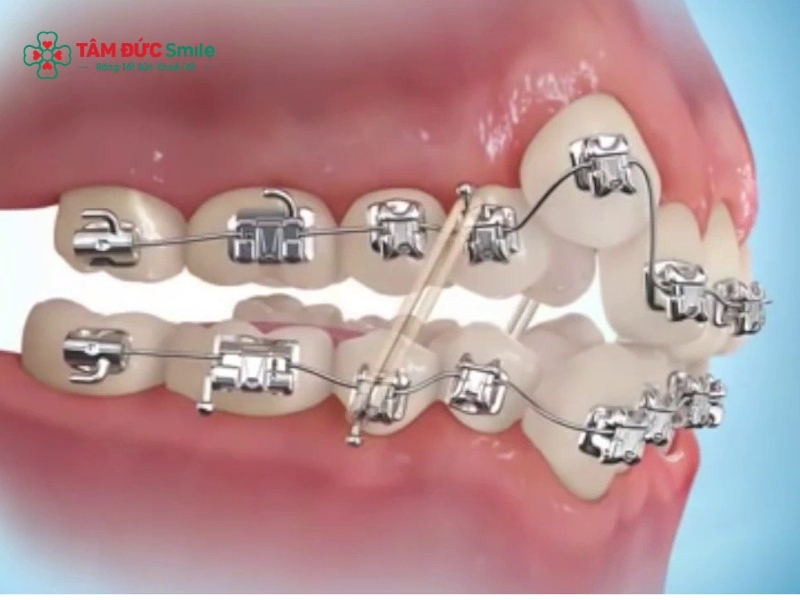 Niềng răng hô nặng: Chi phí, thời gian & phác đồ điều trị chi tiết缩略图