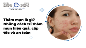 Thâm mụn là gì? Những cách trị thâm mụn hiệu quả, cấp tốc và an toàn缩略图