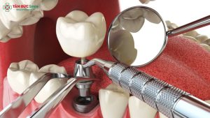 Trồng răng Implant là gì? Giá, Quy trình, Ưu điểm và Phương pháp缩略图