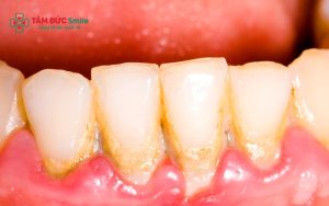 Vôi răng là gì? Tác hại và cách điều trị hiệu quả缩略图