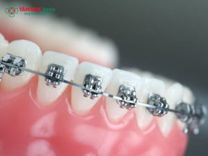 Làm cầu răng sứ có niềng răng được không? 缩略图