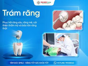 Trám răng là gì? Chi phí, Lợi ích, Quy trình và Địa chỉ uy tín缩略图