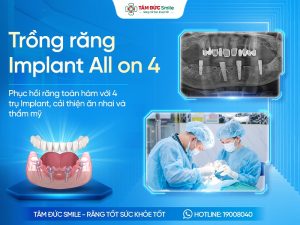 Trồng răng Implant All on 4: Giải pháp cho người mất răng toàn hàm缩略图