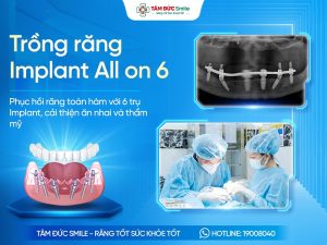 Trồng răng Implant All on 6 là gì? Giá, Ưu điểm, Quy trình và Địa chỉ uy tín缩略图