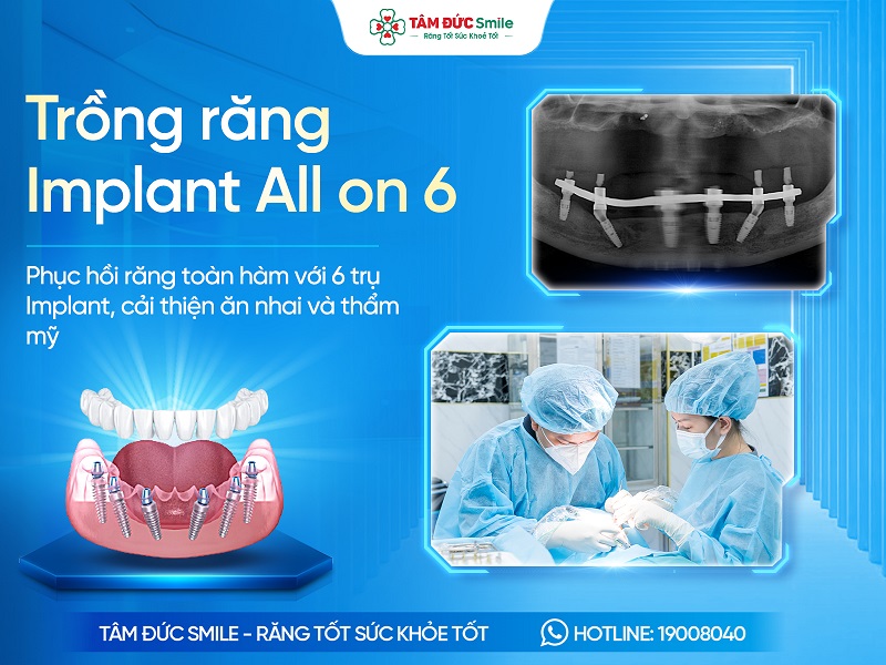 Trồng răng Implant All on 6 là gì? Giá, Ưu điểm, Quy trình và Địa chỉ uy tín缩略图