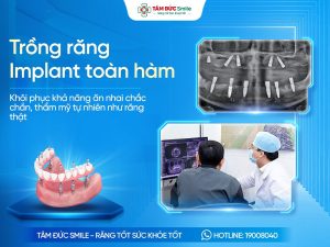 Trồng răng implant toàn hàm là gì? Phương pháp, Chi phí, Ưu điểm và Quy trình thực hiện缩略图